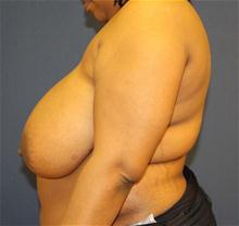 Breast Reduction Before Photo by Laurence Glickman, MD, MSc, FRCS(c),  FACS; Garden City, NY - Case 28000