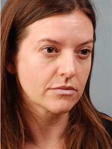 Dermal Fillers Before Photo by Geoffrey Leber, MD, FACS; Scottsdale, AZ - Case 28654