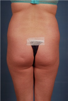 Liposuction Before Photo by Geoffrey Leber, MD, FACS; Scottsdale, AZ - Case 28655