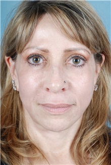 Dermal Fillers After Photo by Geoffrey Leber, MD, FACS; Scottsdale, AZ - Case 28660