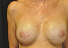 Breast Reconstruction After Photo by Andrew Smith, MD; Irvine, CA - Case 28694