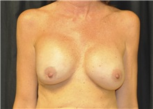 Breast Reconstruction Before Photo by Andrew Smith, MD; Irvine, CA - Case 28694