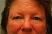 Eyelid Surgery Before Photo by Kristoffer Ning Chang, MD; San Francisco, CA - Case 29766