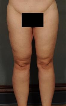 Thigh Lift After Photo by Ellen Janetzke, MD; Bloomfield Hills, MI - Case 29770