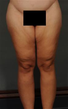 Thigh Lift Before Photo by Ellen Janetzke, MD; Bloomfield Hills, MI - Case 29770