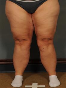 Thigh Lift After Photo by Ellen Janetzke, MD; Bloomfield Hills, MI - Case 29966