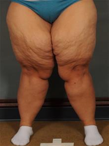 Thigh Lift Before Photo by Ellen Janetzke, MD; Bloomfield Hills, MI - Case 29966