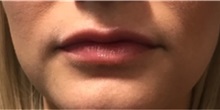 Dermal Fillers After Photo by Timothy Mountcastle, MD; Ashburn, VA - Case 30006