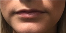 Dermal Fillers Before Photo by Timothy Mountcastle, MD; Ashburn, VA - Case 30006