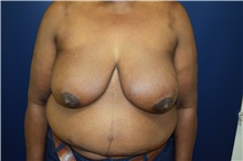 Breast Reconstruction Before Photo by Michael Dobryansky, MD, FACS; Garden City, NY - Case 30294