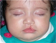 Cleft Lip and Palate Repair Before Photo by Rachel Ruotolo, MD; Garden City, NY - Case 30302