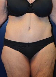 Body Lift After Photo by Matthew Kilgo, MD, FACS; Garden City, NY - Case 30343