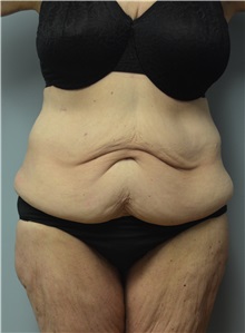 Body Lift Before Photo by Matthew Kilgo, MD, FACS; Garden City, NY - Case 30343