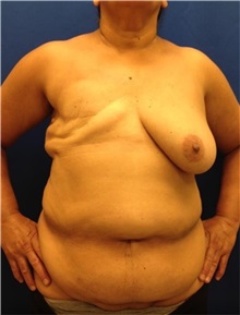 Breast Reconstruction Before Photo by Jerry Weiger Chang, MD, FACS; Flushing, NY - Case 30390