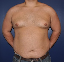 Male Breast Reduction After Photo by Jerry Weiger Chang, MD, FACS; Flushing, NY - Case 30407