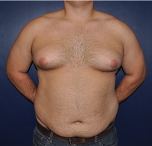 Male Breast Reduction Before Photo by Jerry Weiger Chang, MD, FACS; Flushing, NY - Case 30407