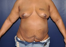 Breast Reconstruction After Photo by Jerry Weiger Chang, MD, FACS; Flushing, NY - Case 30416