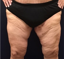 Thigh Lift After Photo by Brian Pinsky, MD, FACS; Huntington Station, NY - Case 30435