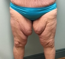 Thigh Lift Before Photo by Brian Pinsky, MD, FACS; Huntington Station, NY - Case 30435