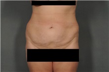 Liposuction After Photo by Ellen Janetzke, MD; Bloomfield Hills, MI - Case 30469