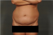 Liposuction Before Photo by Ellen Janetzke, MD; Bloomfield Hills, MI - Case 30469