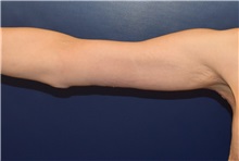 Arm Lift After Photo by Richard Reish, MD, FACS; New York, NY - Case 30561