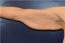 Arm Lift Before Photo by Richard Reish, MD, FACS; New York, NY - Case 30561