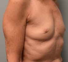 Breast Augmentation Before Photo by Richard Reish, MD, FACS; New York, NY - Case 30575