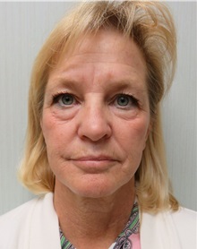 Facelift Before Photo by Richard Greco, MD; Savannah, GA - Case 30632