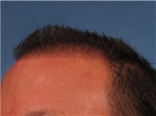 Hair Transplant After Photo by Kent Hasen, MD; Naples, FL - Case 30699