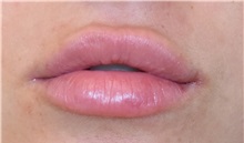 Lip Augmentation/Enhancement After Photo by Richard Reish, MD, FACS; New York, NY - Case 30821