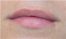 Lip Augmentation/Enhancement Before Photo by Richard Reish, MD, FACS; New York, NY - Case 30821