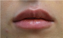 Lip Augmentation/Enhancement After Photo by Richard Reish, MD, FACS; New York, NY - Case 30827