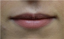 Lip Augmentation/Enhancement Before Photo by Richard Reish, MD, FACS; New York, NY - Case 30827