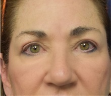 Eyelid Surgery After Photo by Richard Reish, MD, FACS; New York, NY - Case 30923