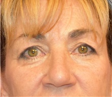 Eyelid Surgery Before Photo by Richard Reish, MD, FACS; New York, NY - Case 30923