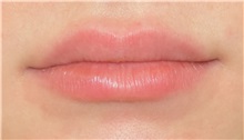 Lip Augmentation/Enhancement After Photo by Richard Reish, MD, FACS; New York, NY - Case 30931