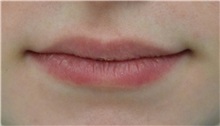 Lip Augmentation/Enhancement Before Photo by Richard Reish, MD, FACS; New York, NY - Case 30931