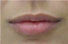 Lip Augmentation/Enhancement Before Photo by Richard Reish, MD, FACS; New York, NY - Case 30933