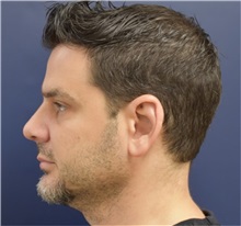 Rhinoplasty After Photo by Richard Reish, MD, FACS; New York, NY - Case 30954