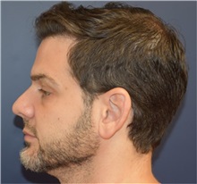 Rhinoplasty Before Photo by Richard Reish, MD, FACS; New York, NY - Case 30954