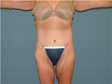 Body Lift After Photo by Arturo Guiloff, MD; Palm Beach Gardens, FL - Case 31151