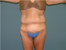 Body Lift Before Photo by Arturo Guiloff, MD; Palm Beach Gardens, FL - Case 31151