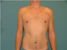 Male Breast Reduction After Photo by Arturo Guiloff, MD; Palm Beach Gardens, FL - Case 31153