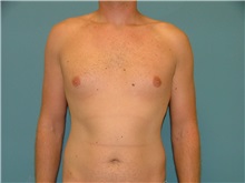 Male Breast Reduction Before Photo by Arturo Guiloff, MD; Palm Beach Gardens, FL - Case 31153