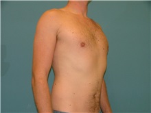 Male Breast Reduction After Photo by Arturo Guiloff, MD; Palm Beach Gardens, FL - Case 31153