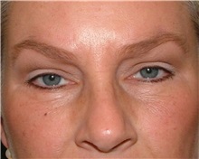 Brow Lift After Photo by Arturo Guiloff, MD; Palm Beach Gardens, FL - Case 31179