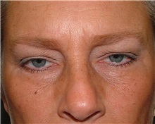 Brow Lift Before Photo by Arturo Guiloff, MD; Palm Beach Gardens, FL - Case 31179