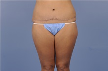 Tummy Tuck After Photo by Trent Douglas, MD; Greenbrae, CA - Case 31402