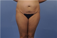 Tummy Tuck Before Photo by Trent Douglas, MD; Greenbrae, CA - Case 31402